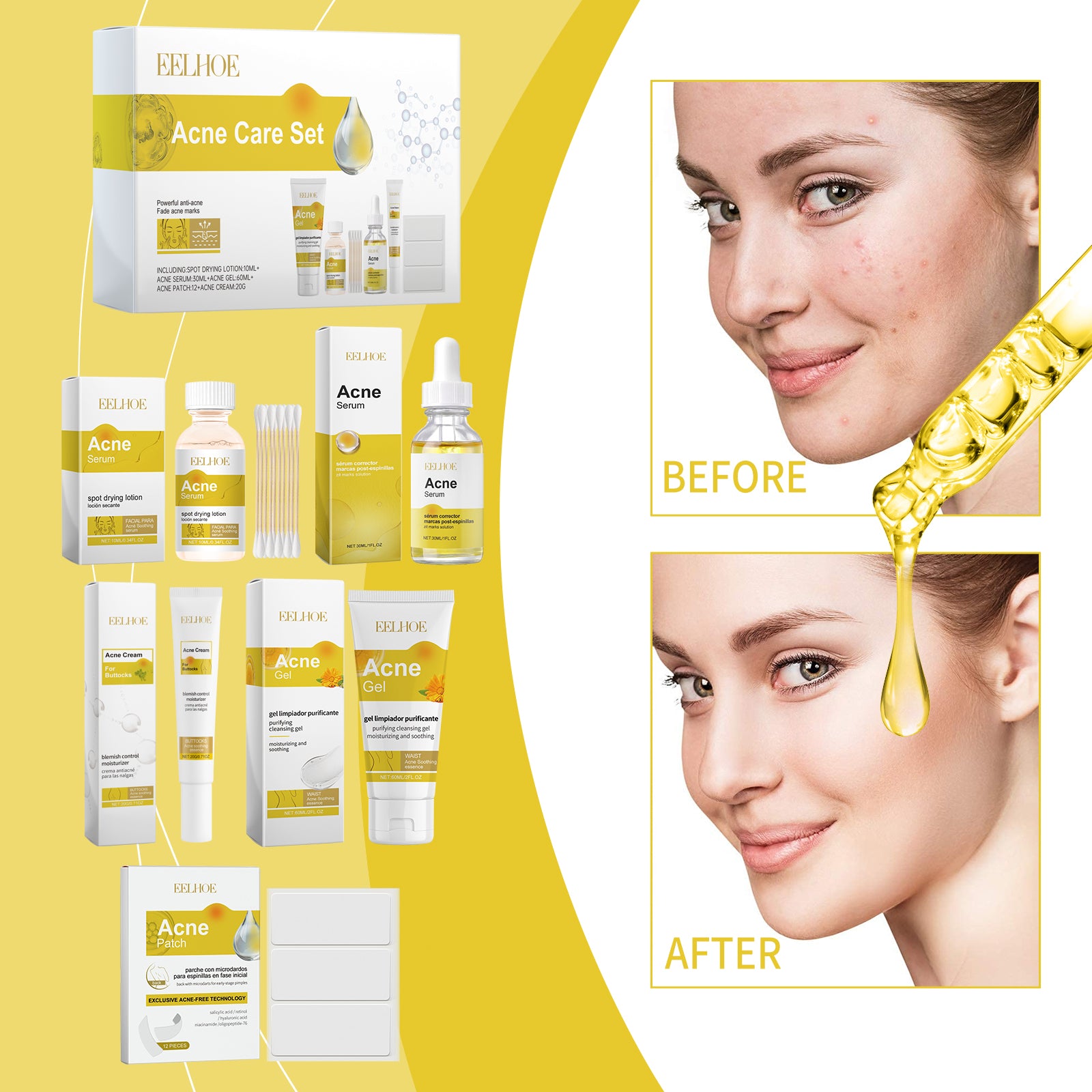 Acne Care Skincare Set — Moisturizing Routine for Blemish-Prone Skin — product photo 2