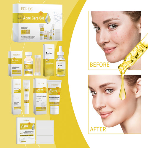 Acne Care Skincare Set — Moisturizing Routine for Blemish-Prone Skin — product photo 2
