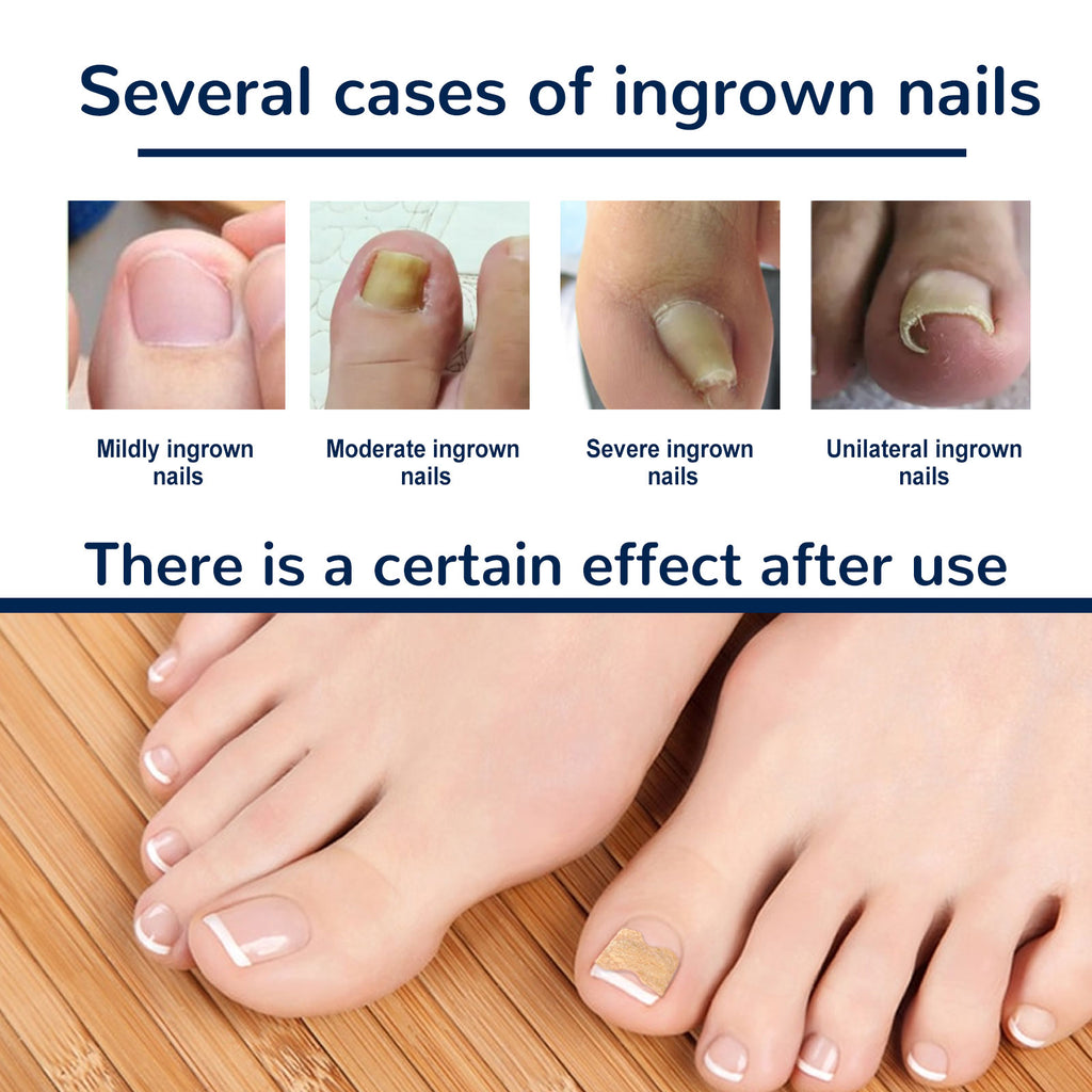 Toe Nail Care Patches — Cushioning Comfort Support for Nails — product photo 5