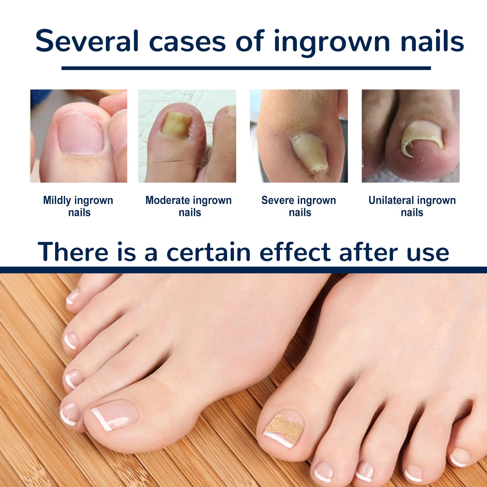 Toe Nail Care Patches — Cushioning Comfort Support for Nails — product photo 5