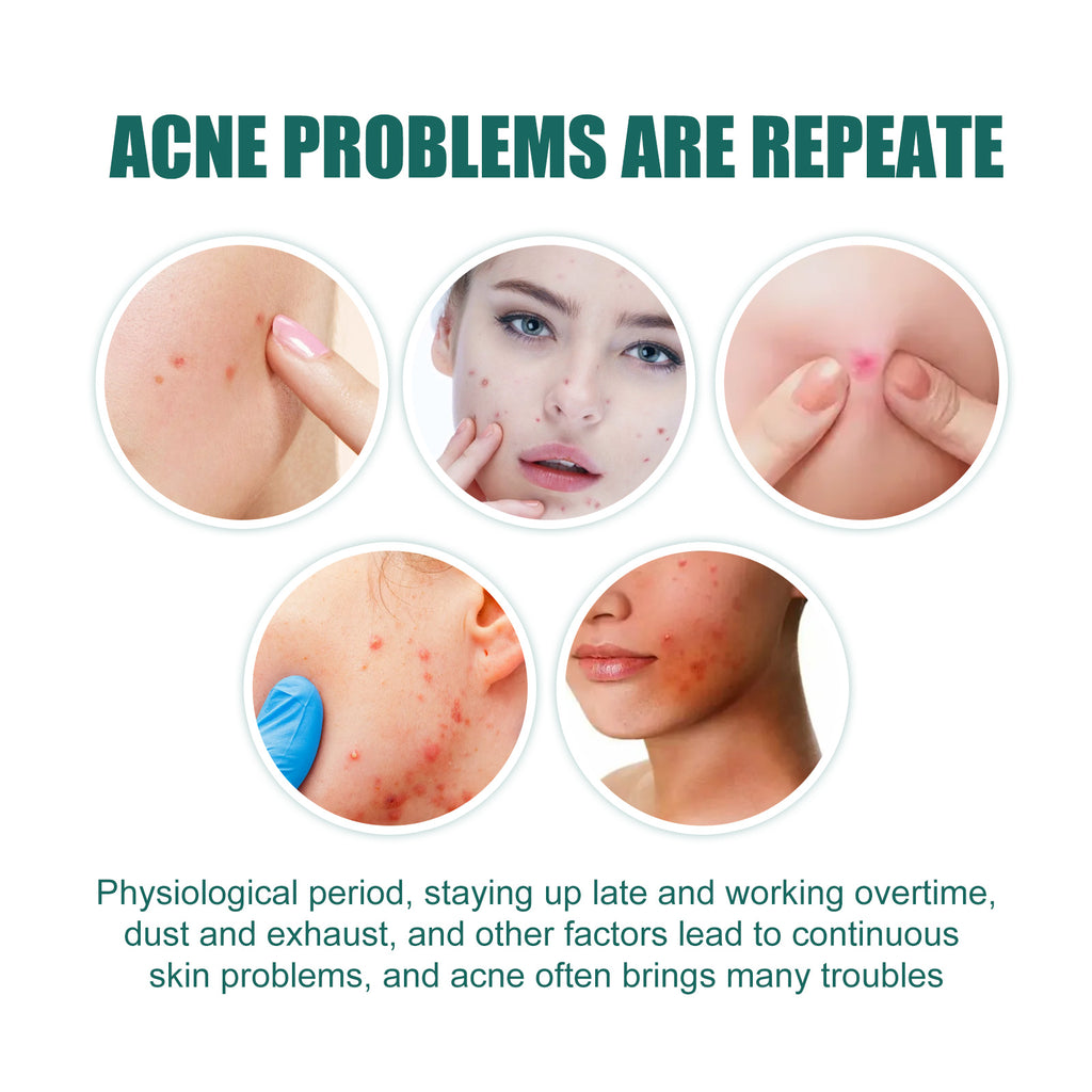EELHOE Star Acne Patches — Cute Blemish-Calming Skin Stickers — product photo 3