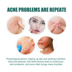EELHOE Star Acne Patches — Cute Blemish-Calming Skin Stickers — product photo 3