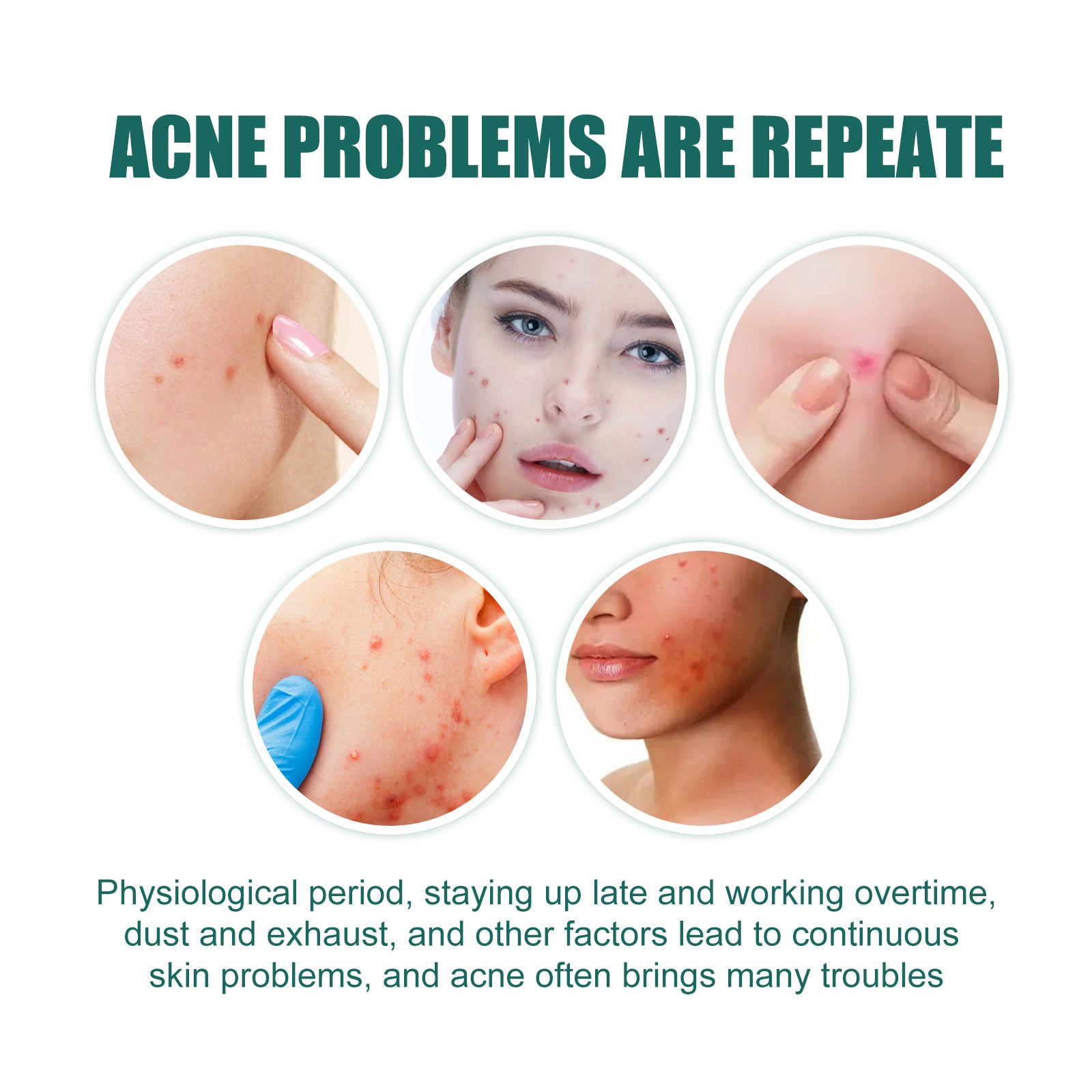 EELHOE Star Acne Patches — Cute Blemish-Calming Skin Stickers — product photo 3